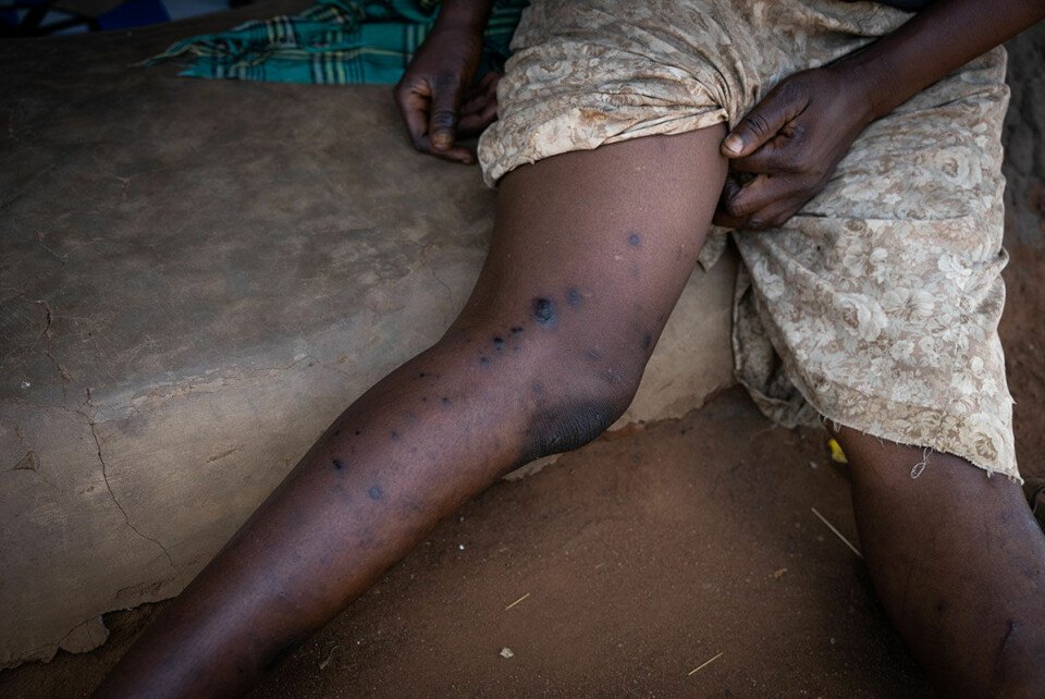 Under skjørtet har fembarnsmoren Nyivuru Grace (42) bein som er fulle av sår fra gummikuler og slag.
