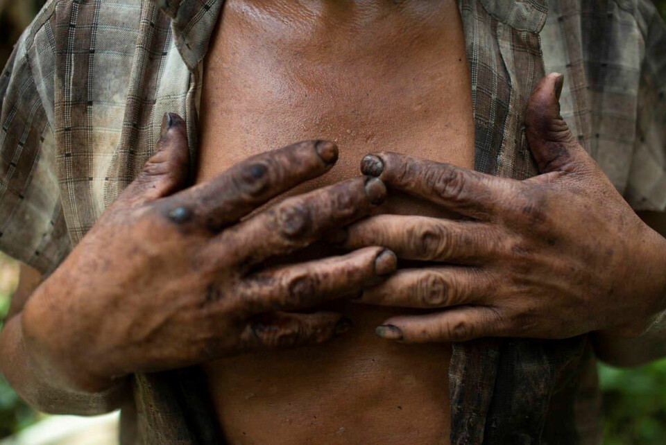 Ødelagte armer, fingre og føtter kjennetegnet mange av arbeiderne som jobbet med å sanke, skjære og bearbeide plantefibrene fra abaca-planten. Fibrene ble solgt til blant annet bilindustrien.