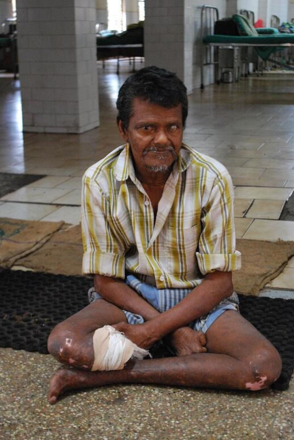 Indias spedalske kjemper mot fordommer.