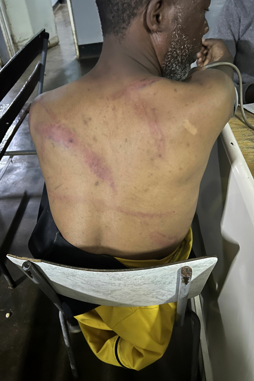 39 år gamle Shadreck Nakoma viser fram skadene på ryggen etter å ha blitt banket av regjeringstilhengere da ha drev valgkamparbeid i Norten vest for hovedstaden.